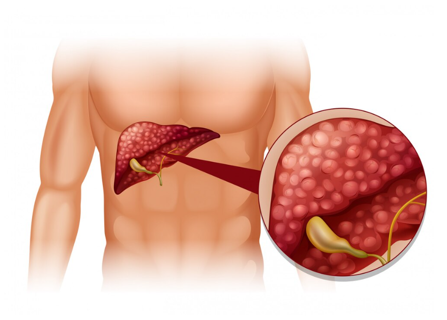 Hipercolesterolemia